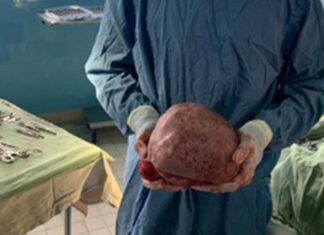 O femeie a renăscut după ce a scăpat de o tumoră uriașă