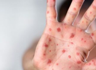 Hipnotizate de coronavirus autoritățile nu spun nimic de epidemia de rujeolă. 20.204 cazuri raportate și 64 de decese!