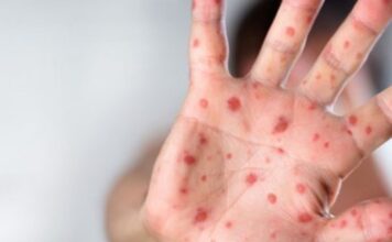 Hipnotizate de coronavirus autoritățile nu spun nimic de epidemia de rujeolă. 20.204 cazuri raportate și 64 de decese!
