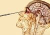 Lobotomia, practica barbară agreată de medicina secolului trecut