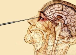 Lobotomia, practica barbară agreată de medicina secolului trecut