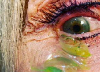 Un medic oftalmolog a scos 23 de lentile de contact din ochii unei paciente Captură video: Instagram