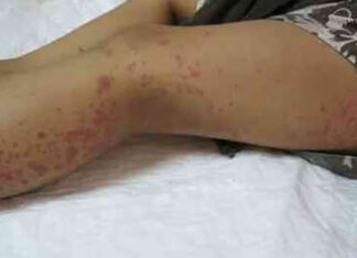 Tânăr din Iași, diagnosticat cu leptospiroză Leptospiroza