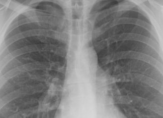 Un spital din Timișoara este dotat cu un aparat ce identifică foarte rapid tuberculoza Sursa foto: Pixabay