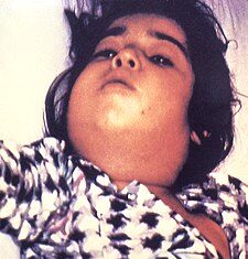 Două cazuri de difterie, confirmate în România, după 34 de ani Difterie