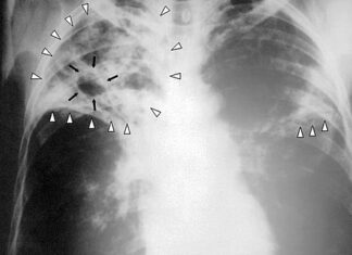 Tuberculoza a redevenit cauza principală a deceselor provocate de bolile infecțioase Tuberculoza